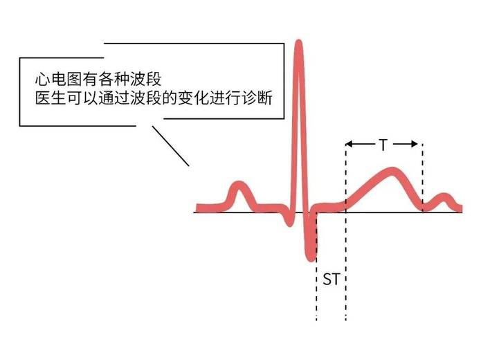 心电图中的四条线分别表示什么?