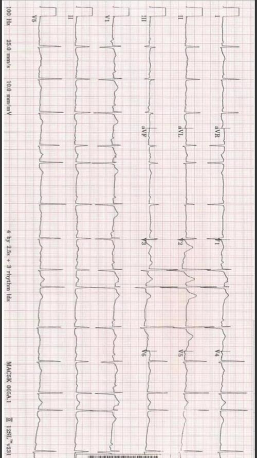 60种常见心电图一览(第一篇-器质性改变)