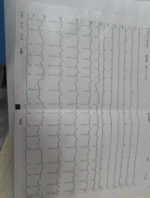 60种常见心电图一览(第一篇-器质性改变)
